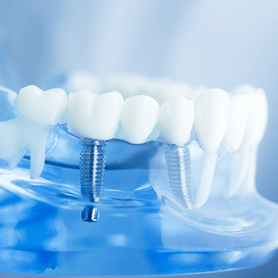 Restorative Dentistry Walnut Grove